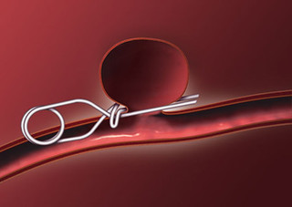 Surgical Clipping