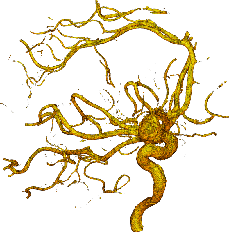 Brain Aneurysm