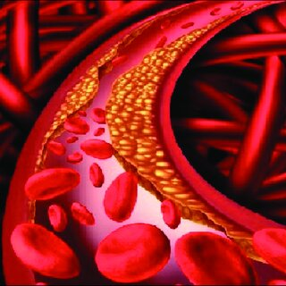 Dyslipidemia: a growing concern for everyone