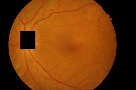 AI in heatlhcare (Ophthalmology)